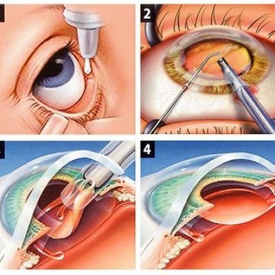 Cirurgia para Catarata com facoemulsificador Alcon Infiniti e lentes Premium