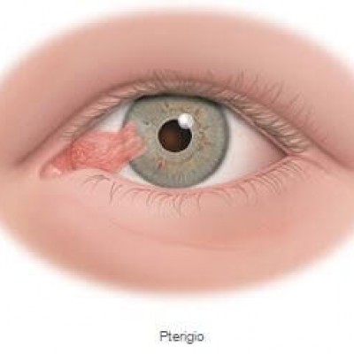 Cirurgia de Pterígio com recobrimento conjuntival e cola biológica