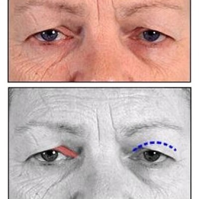 Cirurgia para Blefarocalase (excesso de pele palpebral) e cistos palpebrais